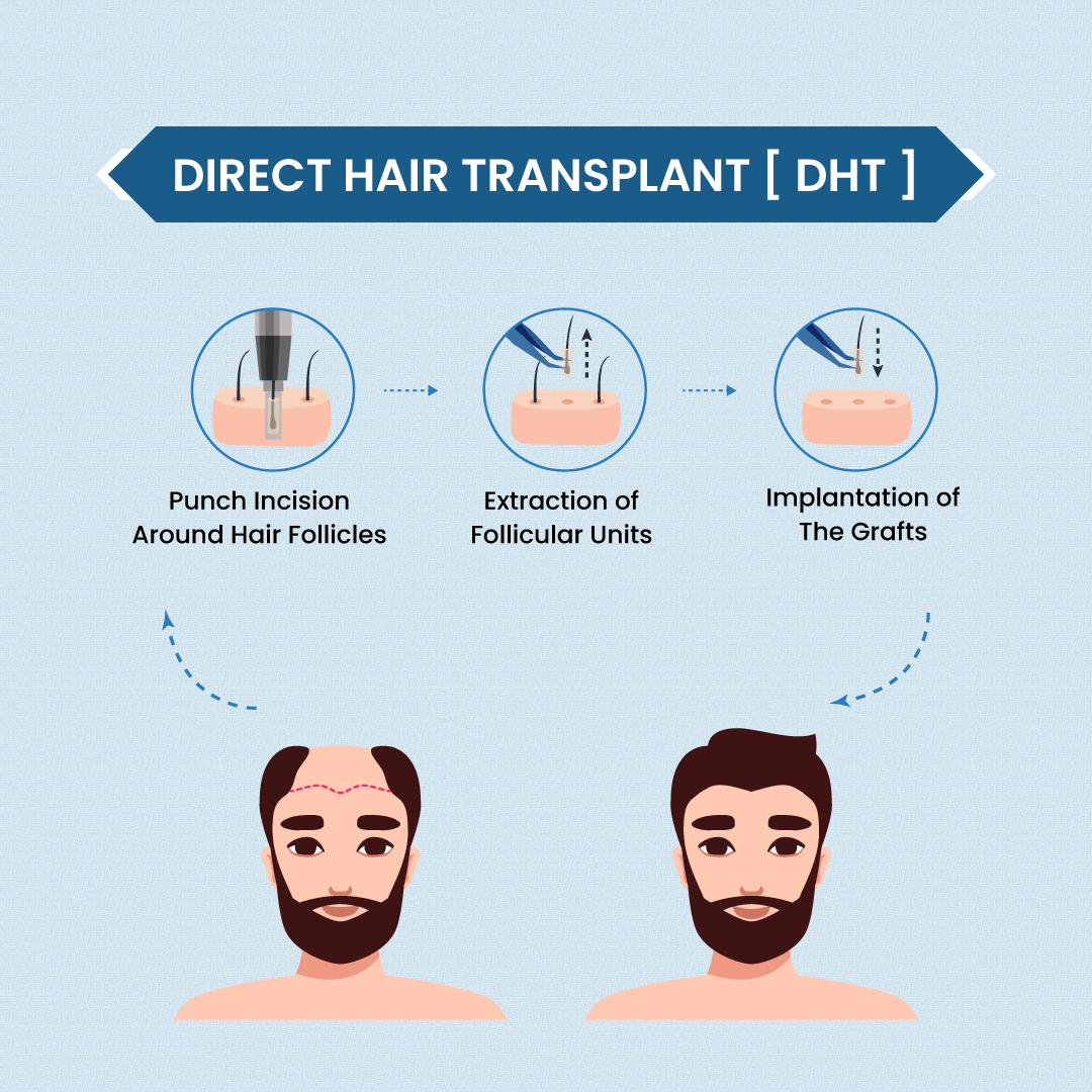 DHT (Direct Hair Transplant) process, a popular method for hair restoration in Nepal. This advanced technique ensures natural-looking results and is a preferred choice for those seeking effective hair transplant solutions in Nepal.
