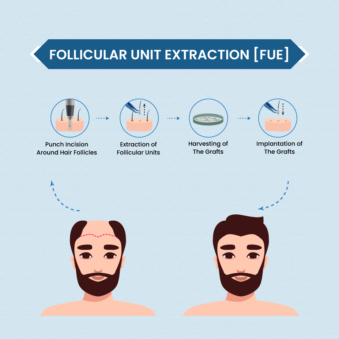 Step-by-step process of the FUE (Follicular Unit Extraction) hair transplant technique, a popular method for hair restoration in Nepal