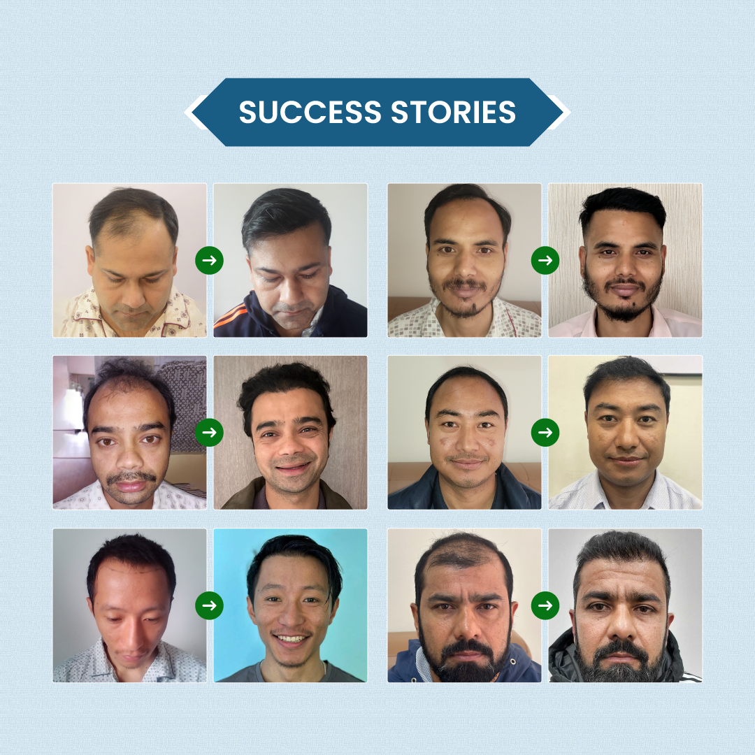 Hair transplant success result at Arogin Health Care in Nepal showcasing natural hair growth and transformation